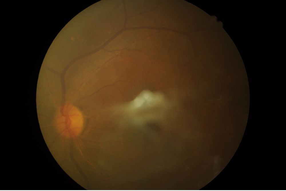 Pneumatic retinopexy Surgery Cost Dubai Eye Clinic